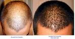 Dutasteride, Avodart, hair loss treatment, pictures from actual ...
