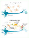 The true behind ALS (Lou Gehrigs disease) - Watch Your Favorite.