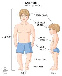 Image result for Nanismo Primordial