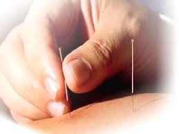 Acupuncture