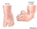 Talipes Deformity Case Study (Clubfoot) | Nursing Crib