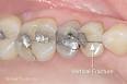 <b>Cracked Tooth Syndrome</b> | Dear