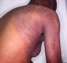Image result for tinea corporis