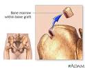 <b>Bone marrow</b> from hip