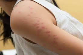 Image result for bed bug bites