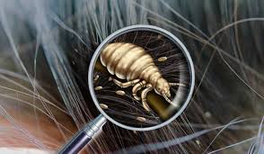 Attēlu rezultāti vaicājumam “Pediculus humanus capitis”