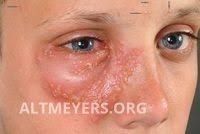 Attēlu rezultāti vaicājumam “Diderma simplex sessile”