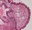 Amyloid - Wikipedia, the free encyclopedia