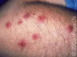 Image result for bed bug bites