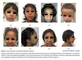 Image result for Nanismo Primordial