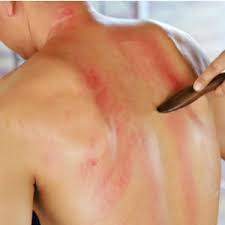 Attēlu rezultāti vaicājumam “Scleroderma”