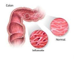 Image result for boala crohn si schizofrenie paranoida