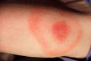 Lyme Disease Pictures Slideshow: Symptoms, Causes, Treatments ...