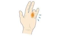 What is a Trigger Finger & How to Manage Hand Discomfort ...