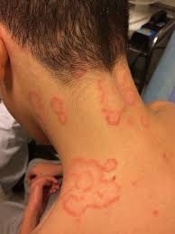 Image result for tinea corporis