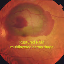 Attēlu rezultāti vaicājumam “Reticularia jurana macro”