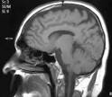 de <b>trombosis</b> de <b>senos</b>