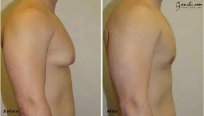 Image result for manboobs