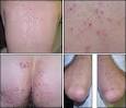 Gluten-Sensitive Enteropathy (Celiac Disease): More Common than ...