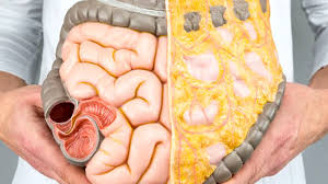 Image result for boala crohn si schizofrenie paranoida