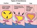 Stress <b>Urinary Incontinence</b>