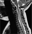 Acute Transverse <b>Myelitis</b>