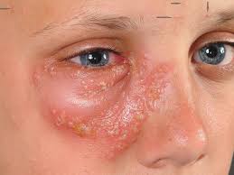 Attēlu rezultāti vaicājumam “Diderma simplex”