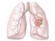 mesothelioma