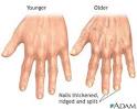  Aging changes in nails: Medline Plus Medical Encyclopedia Image