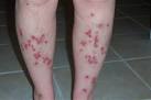 Morgellons Disease Pictures