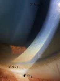 Kuvahaun tulos haulle Kayser-Fleischer