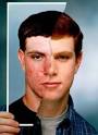 consenso sobre acne