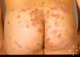 Image result for tinea corporis