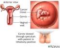 E6 AND CANCER