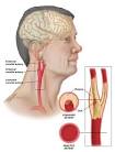 BlueStone Advanced Surgical Care - Carotid Artery Disease