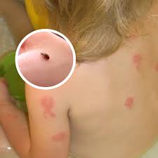 Image result for bed bug bites