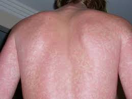 Dengue Fever Rash