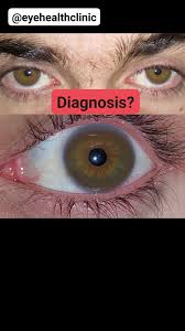 Kuvahaun tulos haulle Kayser-Fleischer