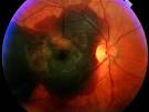 macular degeneration