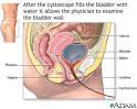 Cystoscopy -