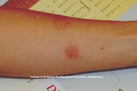 Image result for bed bug bites