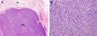 <b>smooth</b>-<b>muscle tumor</b>.