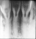 <b>Dentin Dysplasia</b> Type II