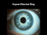 Kuvahaun tulos haulle Kayser-Fleischer