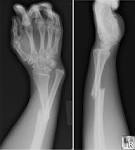Galeazzi <b>Fracture</b>
