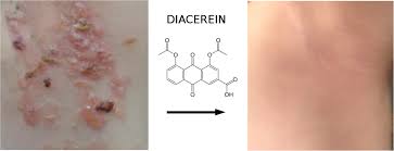 Attēlu rezultāti vaicājumam “Diderma simplex sessile”