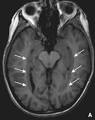 <b>Epilessia parziale continua</b>