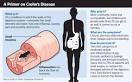 Chrons Disease: Living With