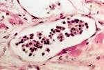 Both <b>follicular carcinoma</b> and
