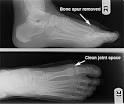 Big Toe Arthritis / Hallux Limitus